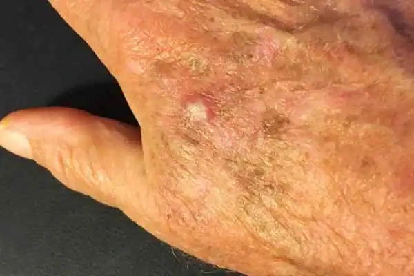 CryoPen for Actinic Keratoses 1 Image of Actinic keratoses Coventry on a person hand